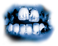 Os ingredientes tóxicos da metanfetamina levam a cáries profundas, o que se conhece como “boca de metanfetamina” nos EUA. Os dentes ficam pretos, manchados e se deterioram até o ponto de precisar serem extraídos. Os dentes e as gengivas são destruídos de dentro para fora e as raízes apodrecem.